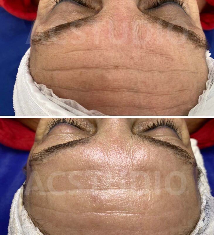 Botox