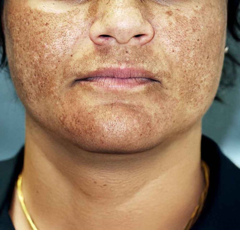Melasma resistente: entender su origen para tratarlo mejor (y sin falsas promesas)